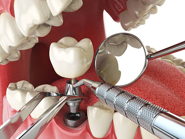 Best Emergency Dental Care for Broken or Chipped Teeth in Becker, MN